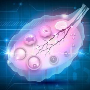 Graphic of polycystic ovary with developing follicles